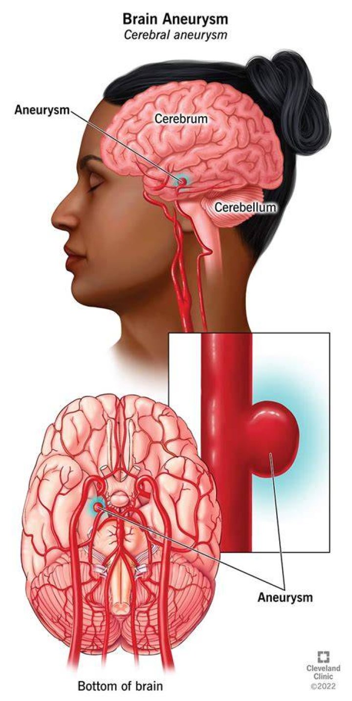 Are brain aneurysms hereditary?