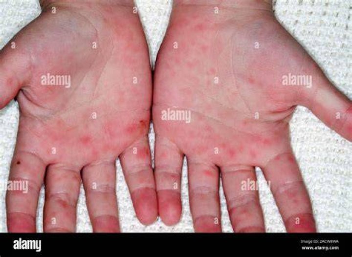 Do hfmd sores itch?