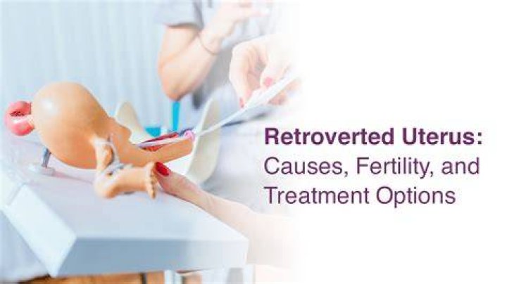 Does a tilted uterus affect fertility?